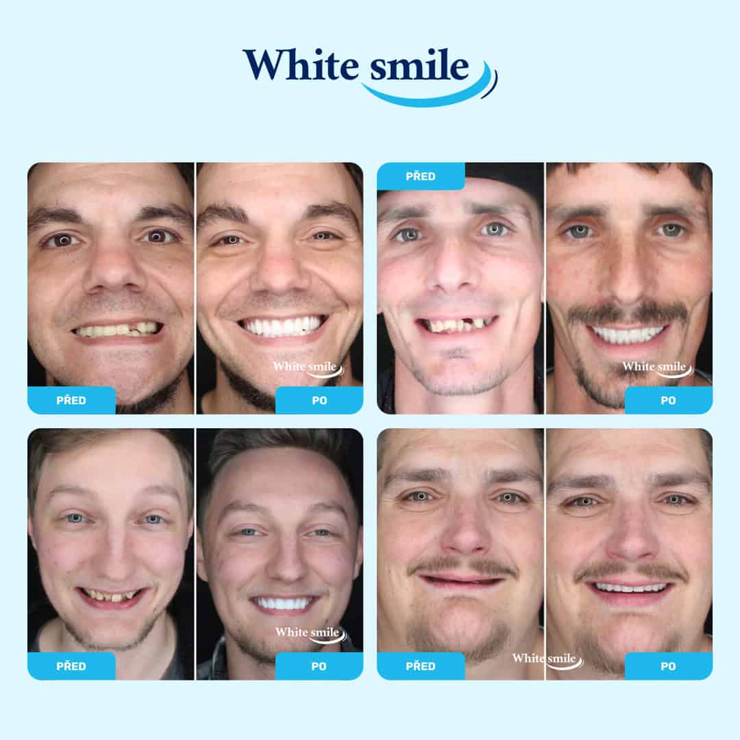 Realisticky vypadající falešné zuby: WhiteSmile - Obrázek 3