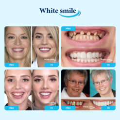 Alternative view of WHITESMILE™ – Nastavitelná Kosmetická Zubní Fazeta